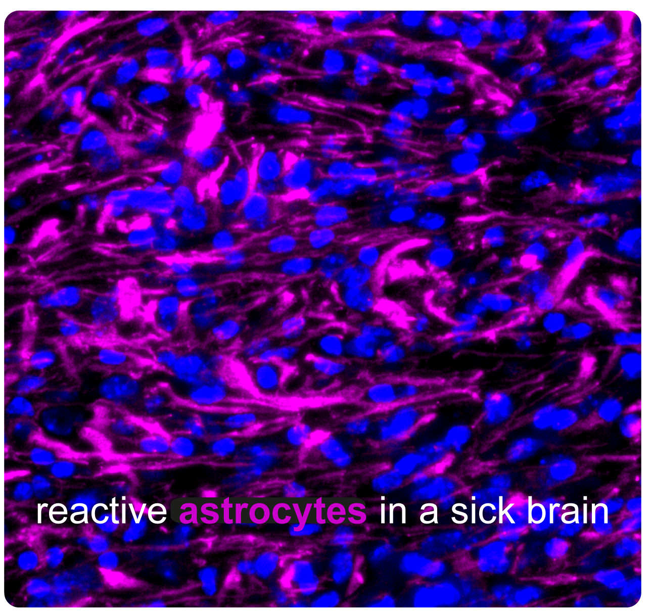 Reactive Astrocytes in a Sick Brain